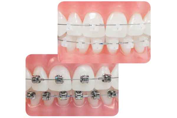 brackets dentista clinica dental molina de segura