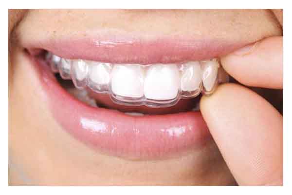 brackets estéticos dentista clinica dental molina de segura