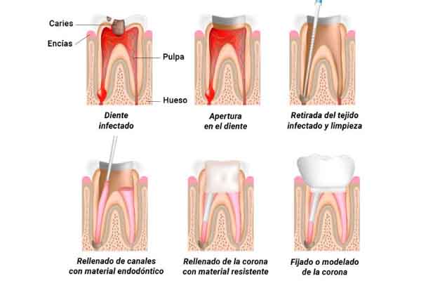 endodoncia clinica dental molina de segura