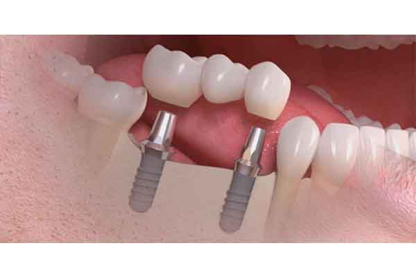 implantes dentista clinica dental molina de segura